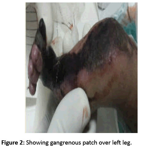 pediatric-infectious-disease-Showing-gangrenous-patch