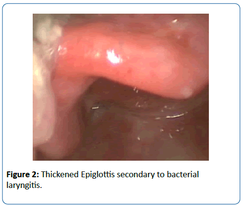 pediatric-infectious-disease-Thickened-Epiglottis
