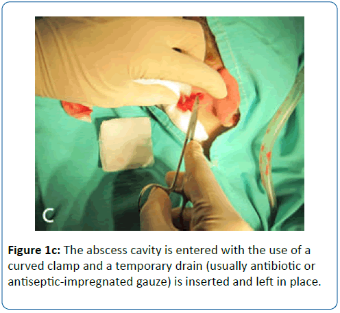 pediatric-infectious-disease-abscess-cavity