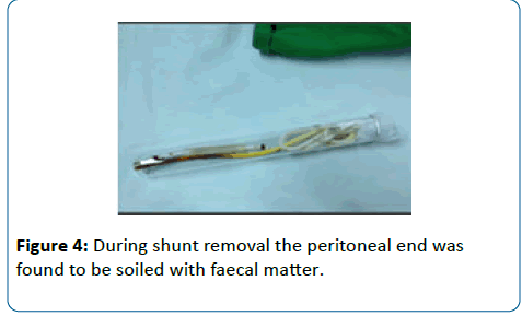 pediatric-infectious-disease-shunt-removal