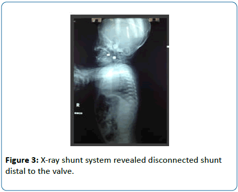 pediatric-infectious-disease-shunt-system