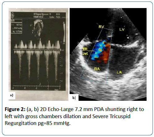 pediatric-infectious-disease-shunting-right